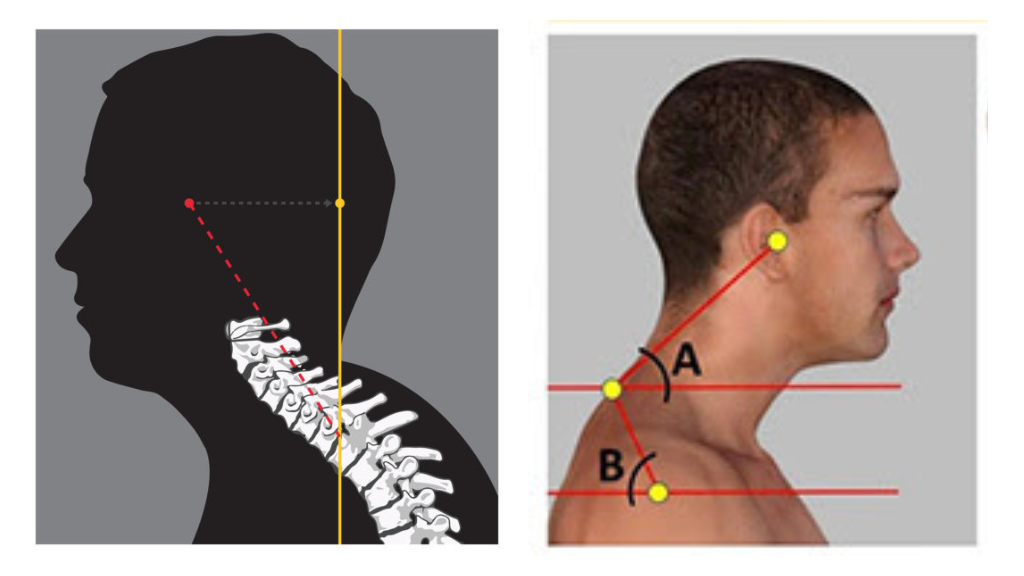 Anterior Spinal Distortion | The Powerhouse Chiropractic